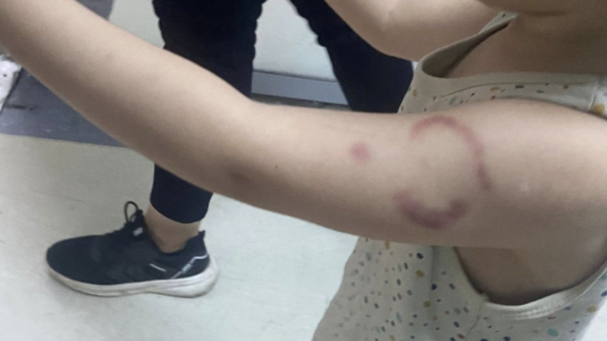 edirnede cocugun kolunu isiran ozel kres ogretmeni hakkinda karar TIDBsJOl.jpg